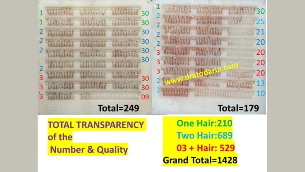 Dr. Atodaria's modern device proving boon for hair transplant surgeons as well as clients - PNN Digital Dr. Atodaria's modern device proving boon for hair transplant surgeons as well as clients - PNN Digital